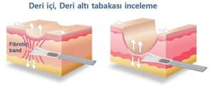 Akne skar izi tedavisi subsizyon tedavisi