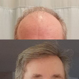 saç ekimi öncesi sonrası, saç ektirdikten sonrası, saç ekimi sonrası ve öncesi görseller