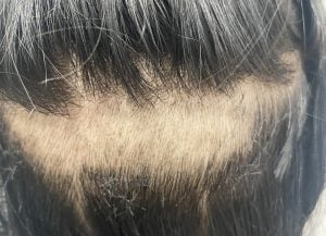 Kadınlarda saç dökülmesi tedavisi, SAÇ EKİMİ