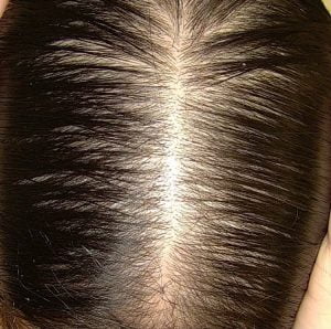 Saç Dökülmesi Tedavisi, Saç Dökülmesi Teşhisi, Saç Kaybı, Saç Dökülmesi Tedavi Yöntemleri