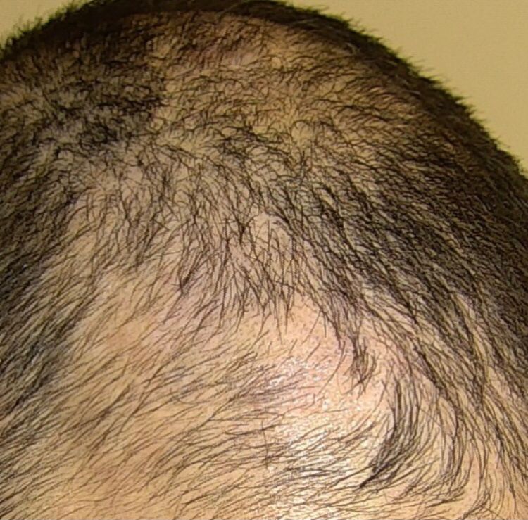 Skatrisyel Alopesi Doc Dr Ekrem Civas Ankara