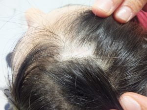 Skarlı Alopesi, Skarlı Alopesi Saç Ekimi,