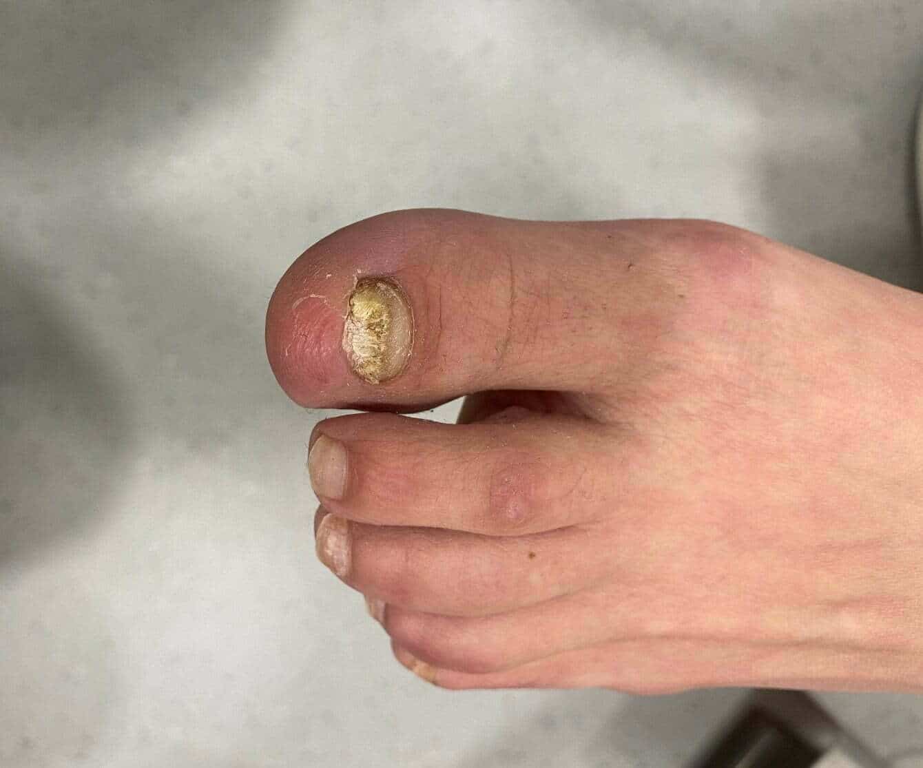 Nail Infection, Fungal (Onychomycosis) Condition, Treatments and Pictures  for Children - Skinsight