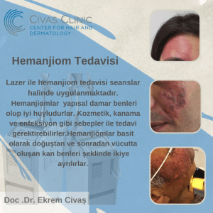 Hemanjiom tedavisi, ankara hemanjiom tedavisi,lazer ile hemanjiom tedavisi,lazer ile hemanjiom tedavisi ankara, ankara hemanjiom tedavisi,hemanjiom,