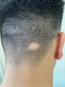 Alopesi areata, Alopesi areata Tedavisi, Alopesi areata saç kıran hastalığı, saç kıran, saç kıran tedavisi Ankara,Alopesi areata Tedavisi Ankara