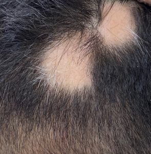 Saç Kıran Hastalığı Tedavisi Nasıldır?