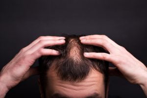 Aşırı Saç Dökülmesi Sebepleri Nelerdir?