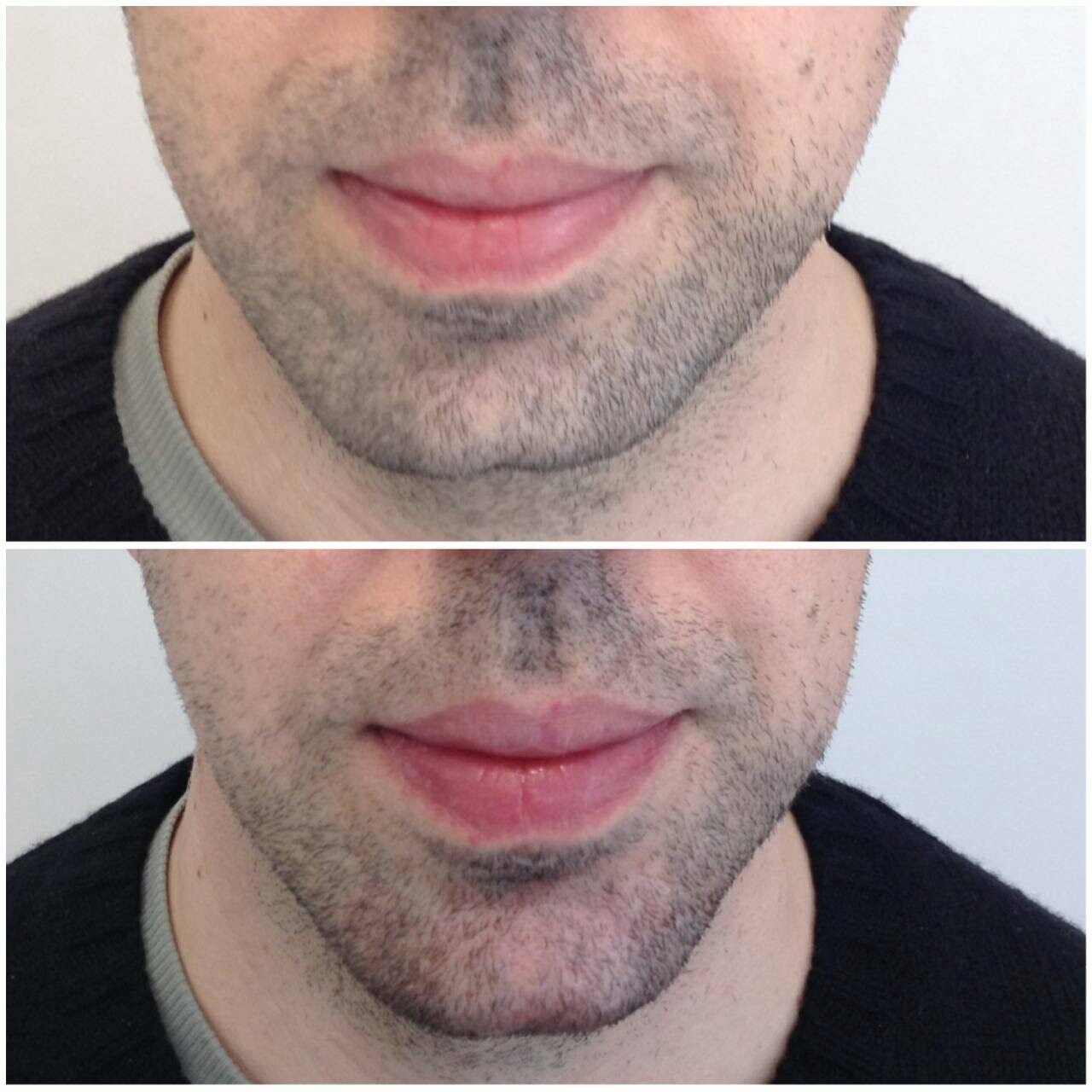 Jawline Çene Dolgusu Ankara Doç. Dr. Ekrem Civas Ankara