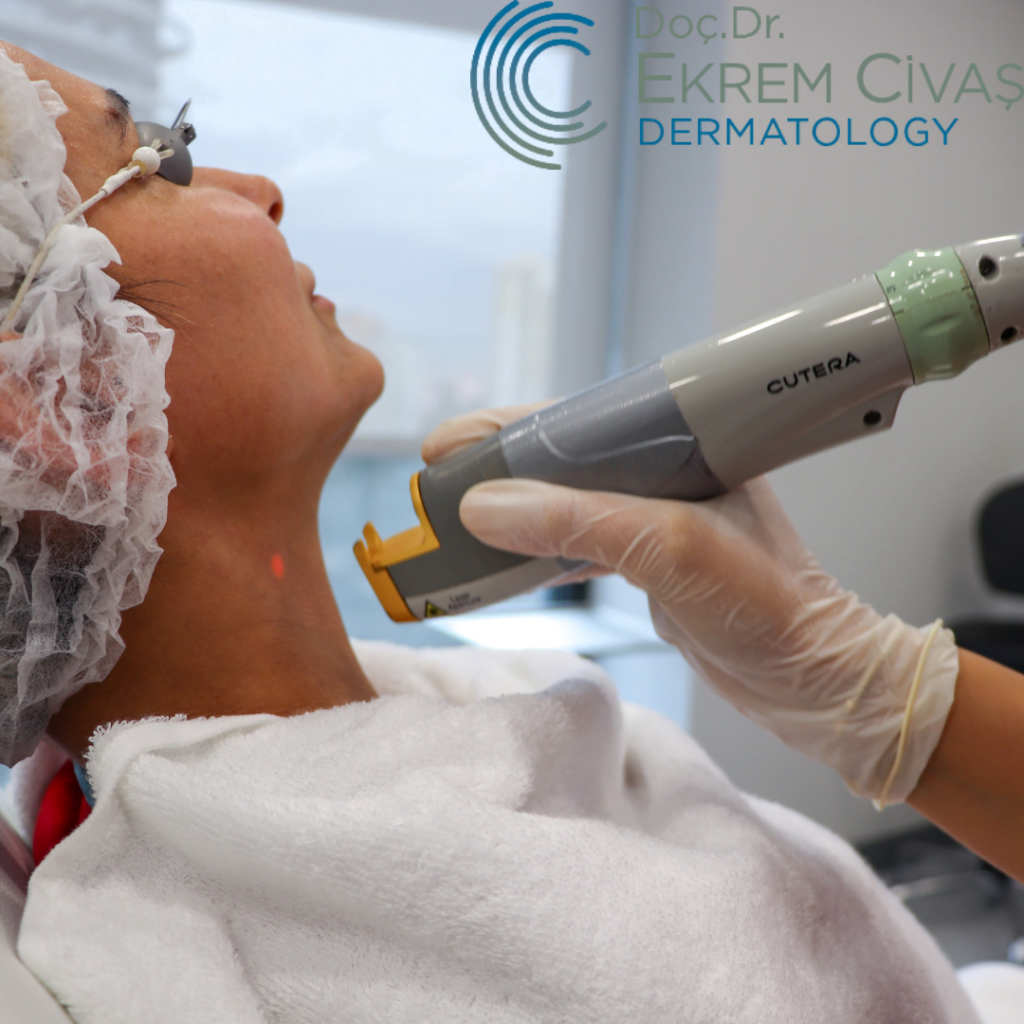 How is Facial Laser Epilation Performed Is Facial Epilation Performed