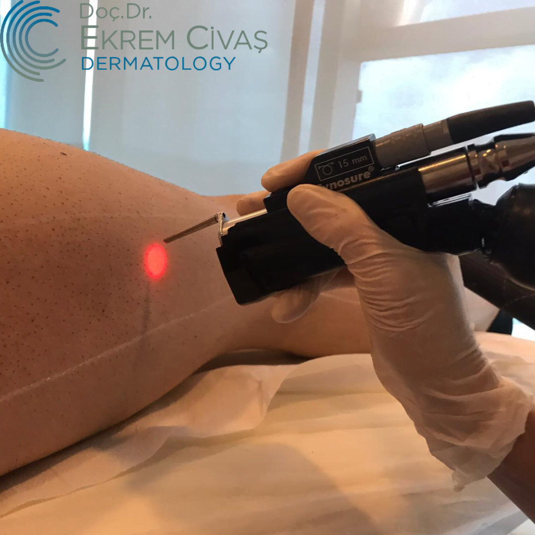 Laser Hair Removal Prices 2023 Doç. Dr. Ekrem Civas Ankara Çayyolu