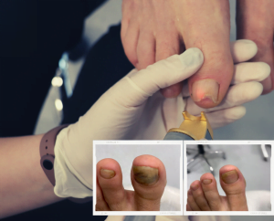 A Complete Guide to Toenail Fungus Treatment | Foot & Ankle