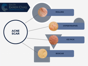 acne scar treatment, ankara acne scar treatment, 