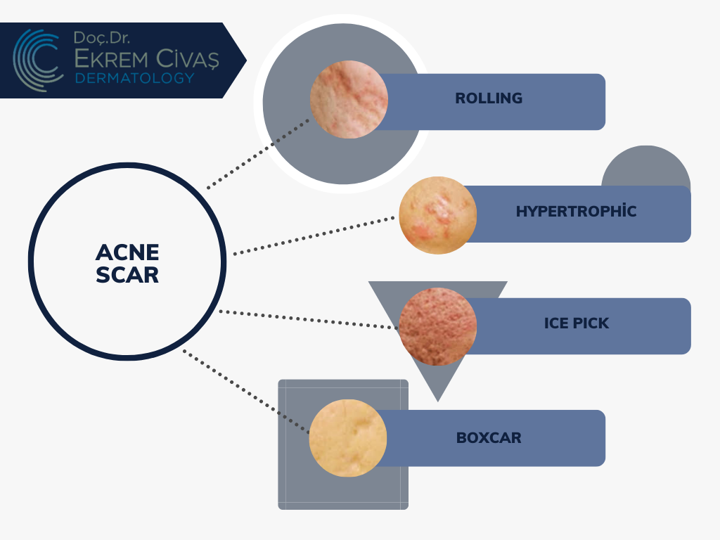 Laser Acne Treatment Ekrem Civas