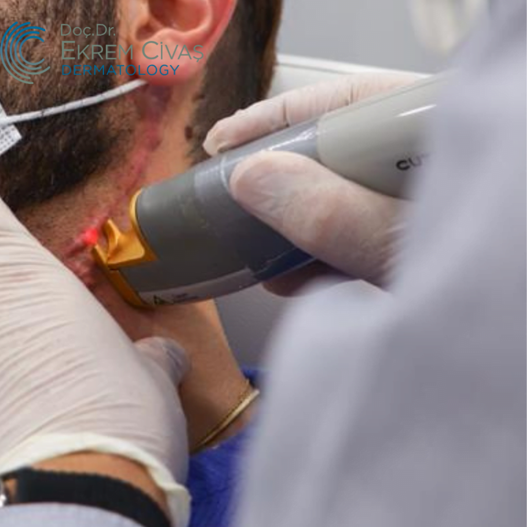 Keloid Scar Scar Treatment Doc.Dr.Ekrem Civas Ankara
