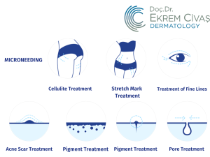 microneedling treatment, microneedling treatment ankara