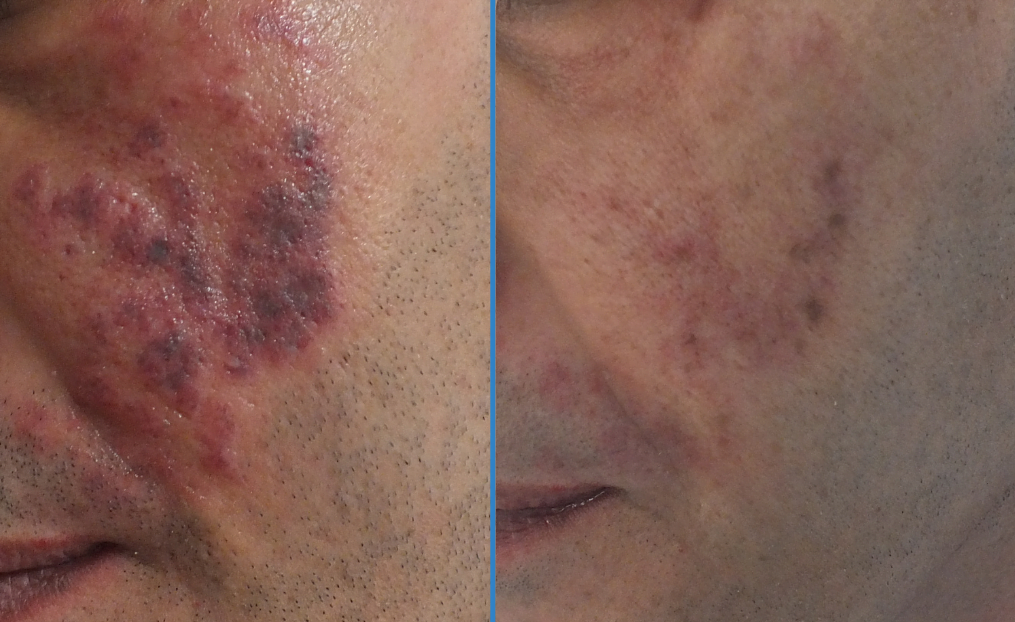 Port Wine Stain Treatment Doç.Dr.Ekrem Civas