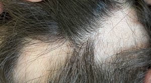 Şiddetli alopesi areata saç kıran tedavisi onaylandı
