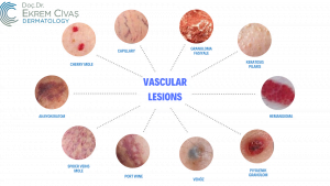 vascular lesions, vascular lesions ankara, vascular lesions treatmant