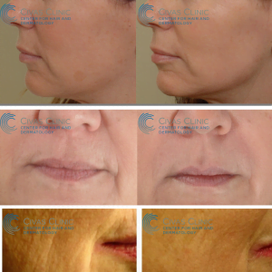 Non-Surgical Skin Lifting, Non-Surgical Skin Lifting Ankara, Ankara Non-Surgical Skin Lifting