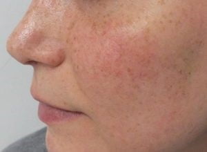 Rosacea treatment Ankara, Rosacea treatment, Rosacea,