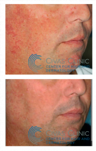 Rosacea treatment Ankara, Rosacea,