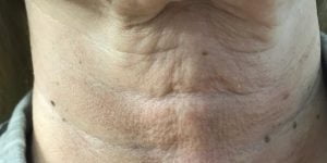 neck filler ankara, ankara neck filler, treatment of neck wrinkles