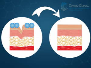 treatment of skin grooves with filler, ankara filler, ankara facial filler