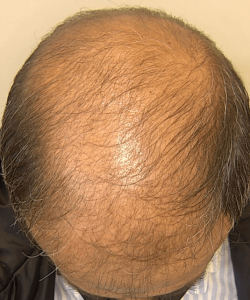saç hastalıkları tedavisi ankara