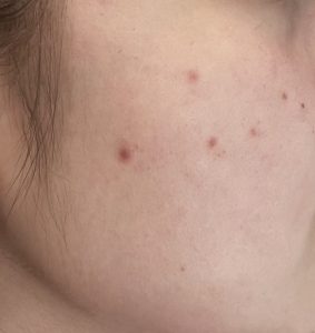 Acne treatment - acne treatment ankara