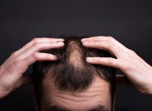 Correction of Poorly Done Hair Transplantation