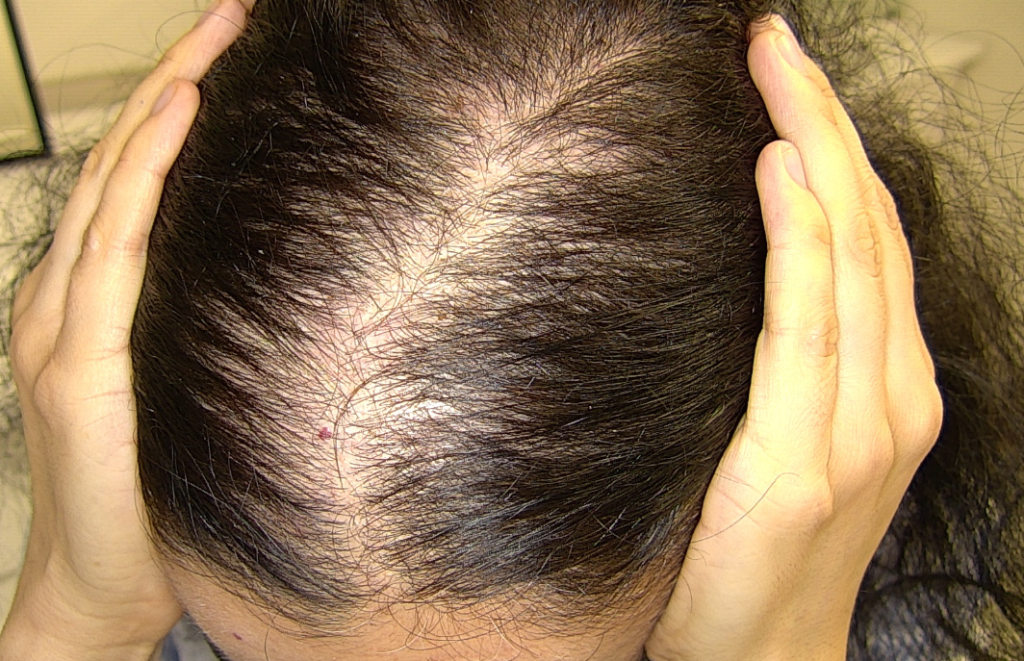 Hair Loss in Women
