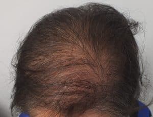 Hair Transplant For Women