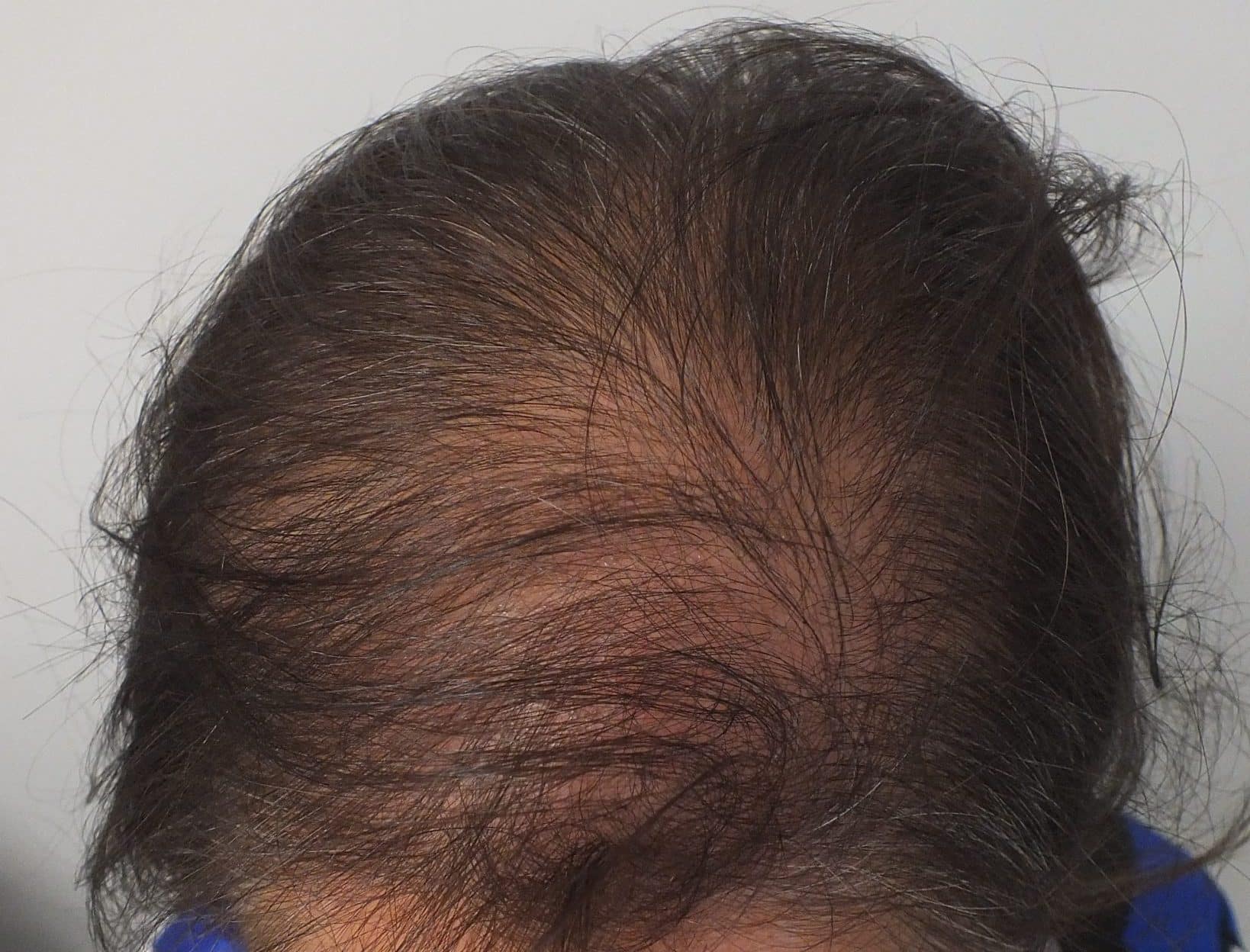 Hair Transplant For Women | Doç.Dr. Ekrem Civas - Ankara