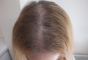 Telogen Effluvium Hair Loss