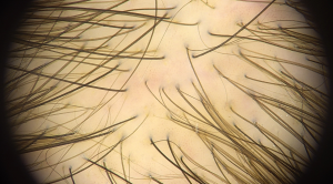 Trichotillomania hair plucking disease