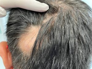 What is Primary Cicatricial Alopecia or Scarring Alopecia