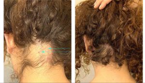 Alopesi areata Saç kıran hastalığı tedavisi Ankara, Saç kıran tedavisi Ankara