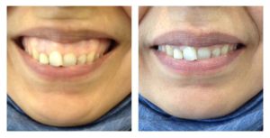 Gummy smile patient photo before and after gum smile treatment