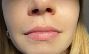 Lip Filling