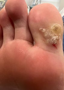 Siğil Tedavisinde 1064 nm NdYAG Lazer Etkili ve Güvenli Bir Yaklaşım