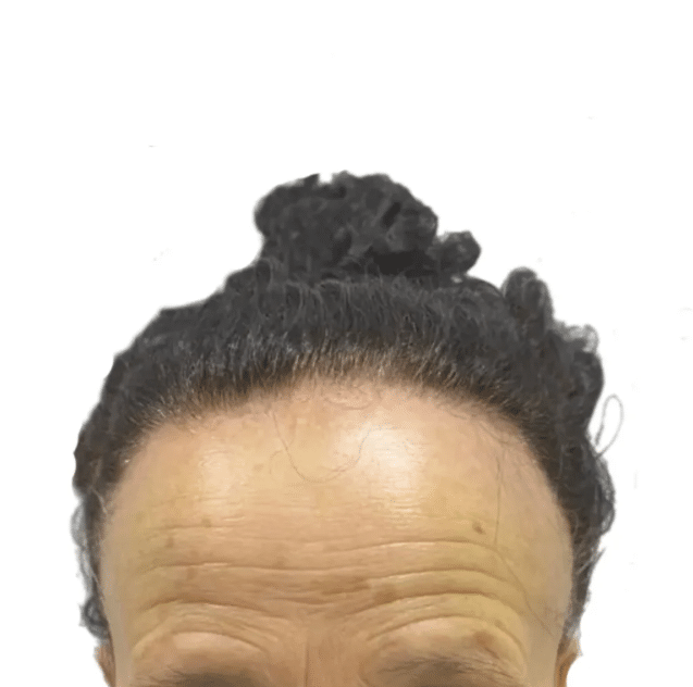 Frontal Fibrozan Alopesi (FFA) Nedir ve FFA Sonrasında Saç Ekimi Yapılabilir mi?