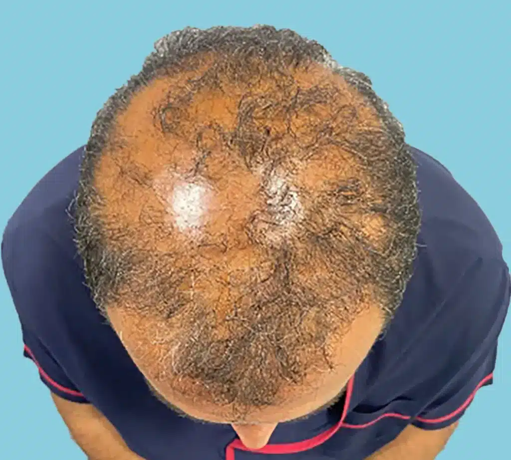 Liken Planopilaris (LPP) Nedir? LPP sonrası saç ekimi düşünenler için rehber: Ne zaman yapılır, kimler için uygundur, riskleri nelerdir?