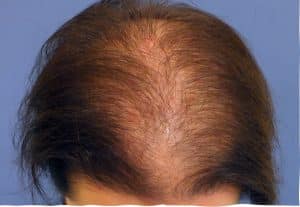 Saç Dökülmesi ve Saç Hastalıklarına Genel Bir Bakış