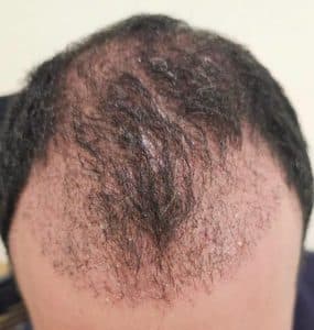 Saç Ekimi Sonrası Folikülit Oluşumu