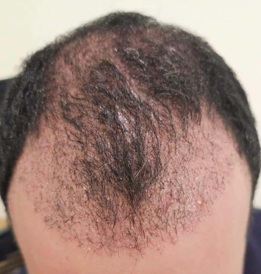 Saç Ekimi Sonrası Folikülit Oluşumu